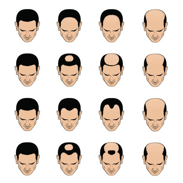 jenis-botak-tengah-male-pattern-baldness-malaysia