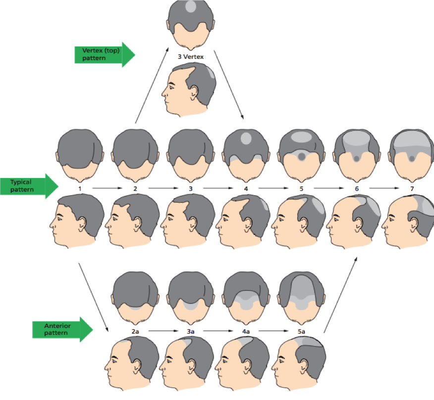 botak-tengah-jenis-male-pattern-baldness