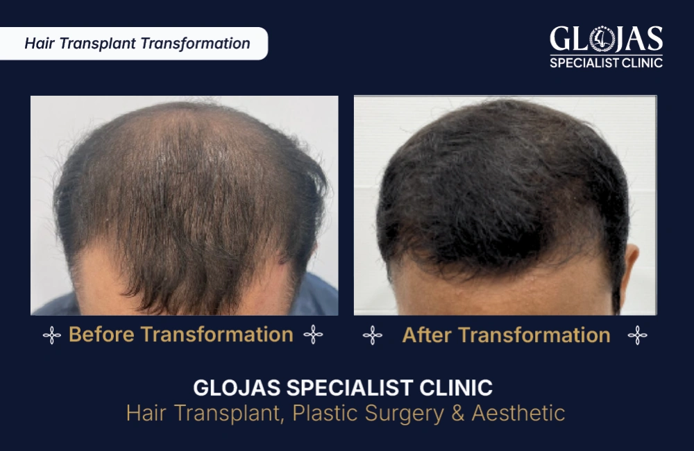hair-transplant-results-kuala-lumpur-malaysia