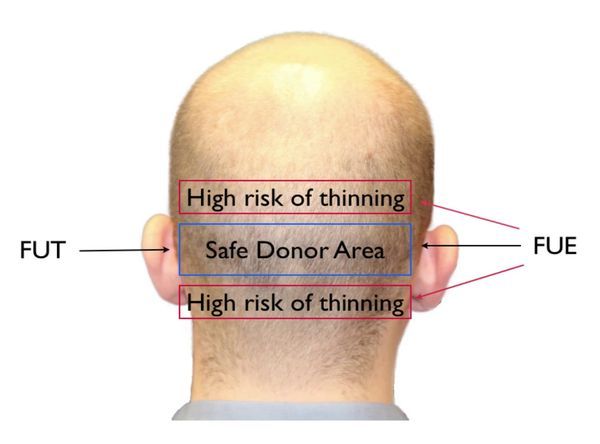 donor-area-hair-transplant
