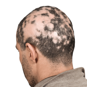 hair-transplant-malaysia-specialist-glojas