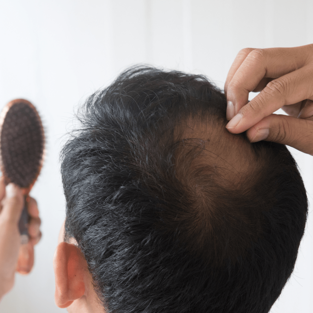 alopecia-areata-hair-loss-hair-transplant-malaysia