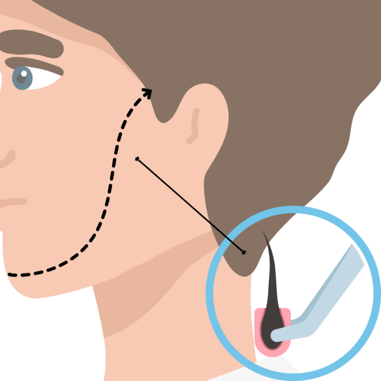 Beard Transplant