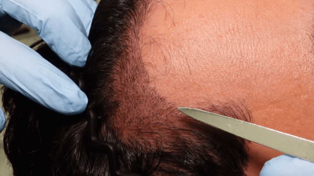 hair-transplant-journey