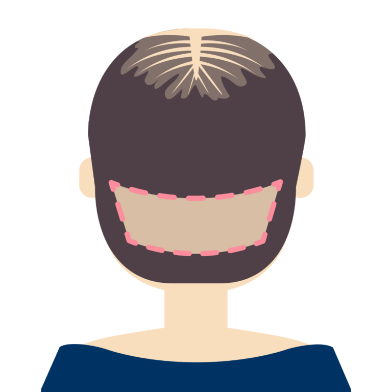 Beard Transplant