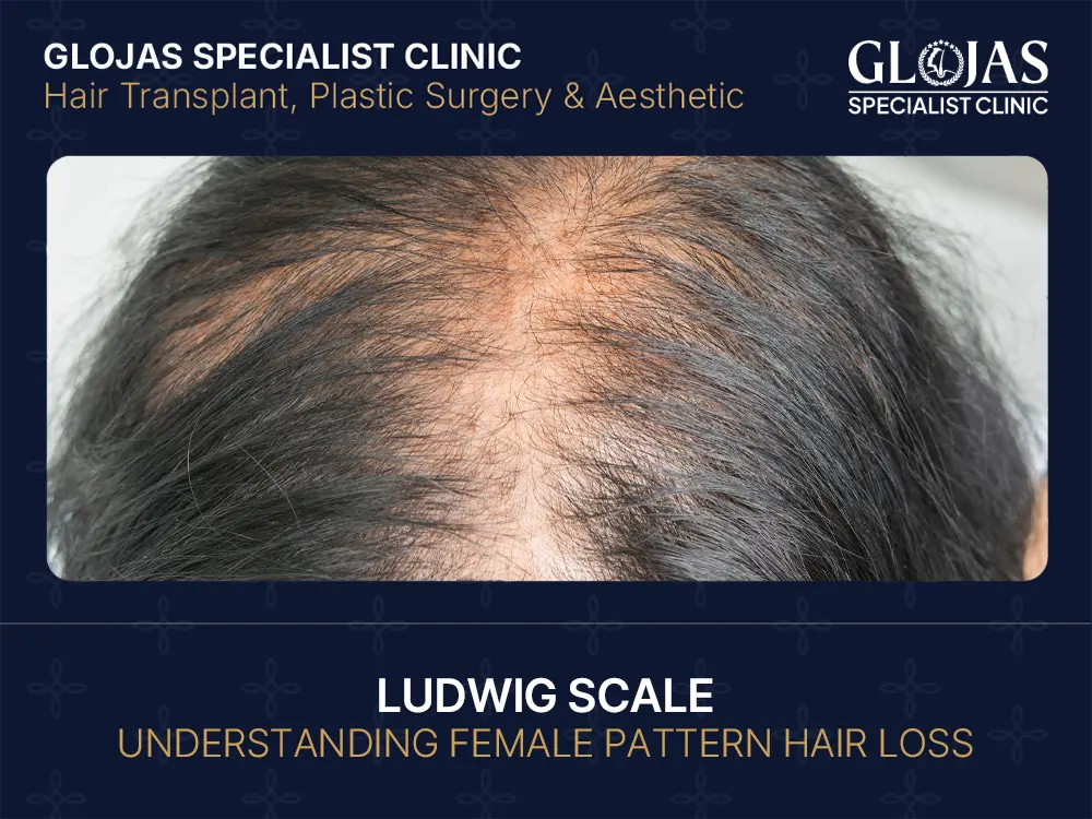 The Ludwig Scale: Understanding Female Pattern Hair Loss 6 ludwig scale female pattern hair loss
