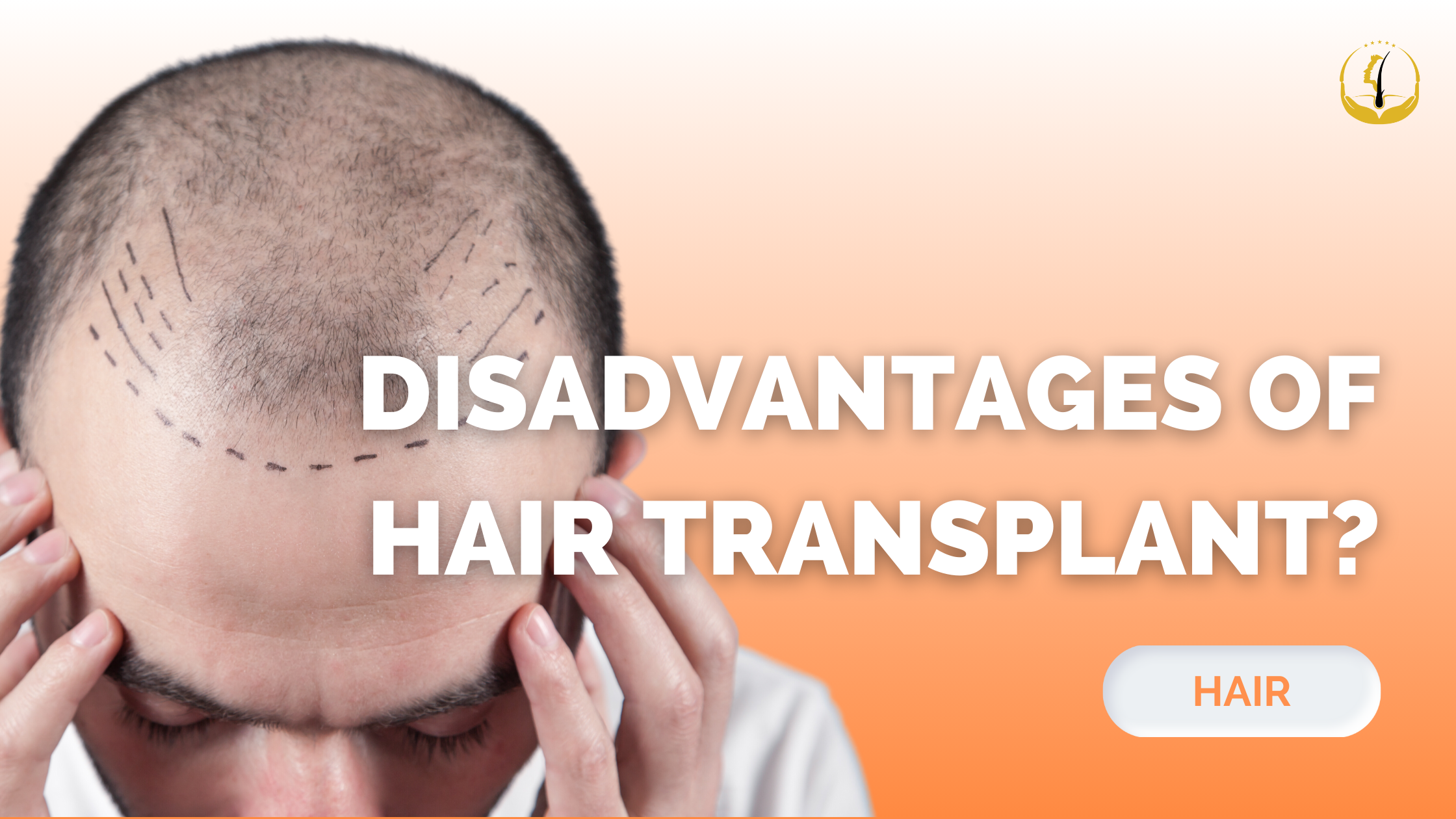 disadvantages-of-hair-transplant