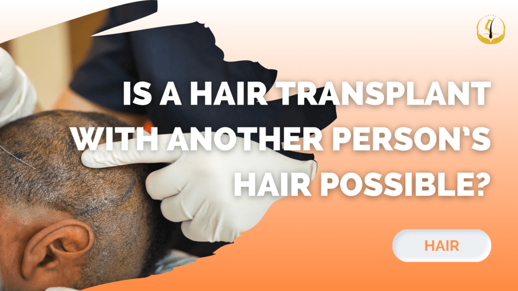 hair-transplant-with-another-person-hair