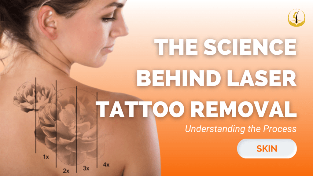 Tattoo Removal