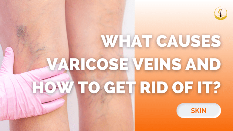 Varicose Veins