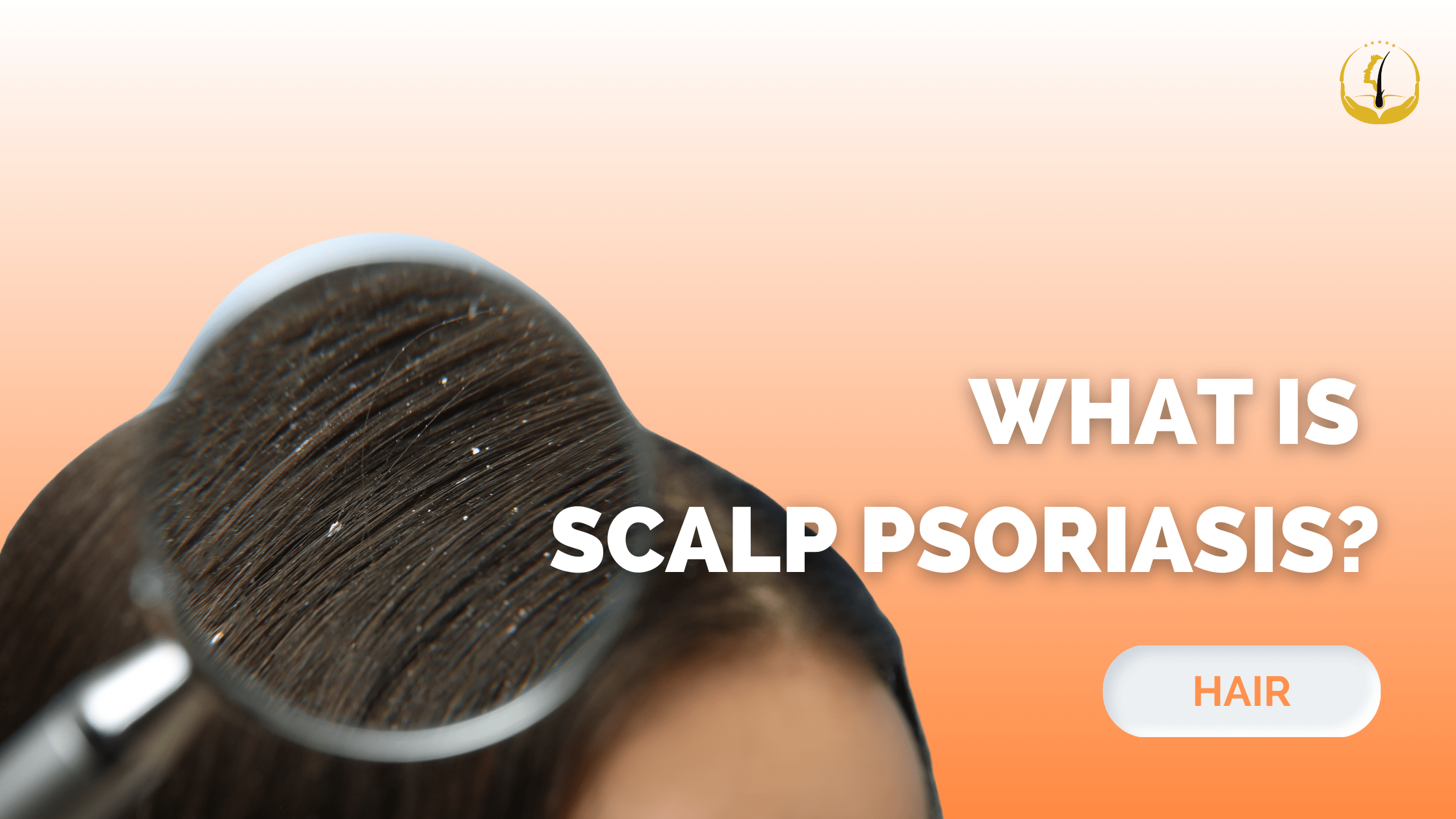 Scalp Psoriasis