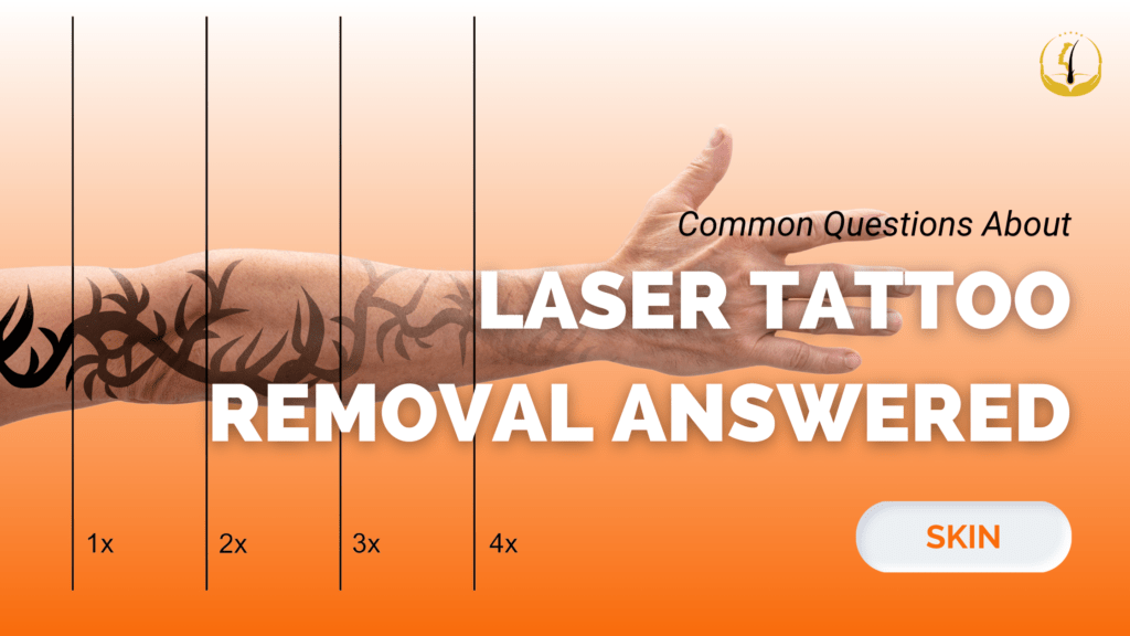 laser-tattoo-removal