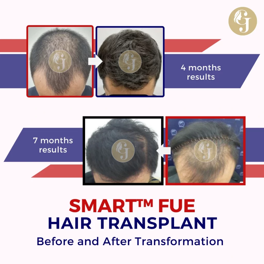 Hair Transplant