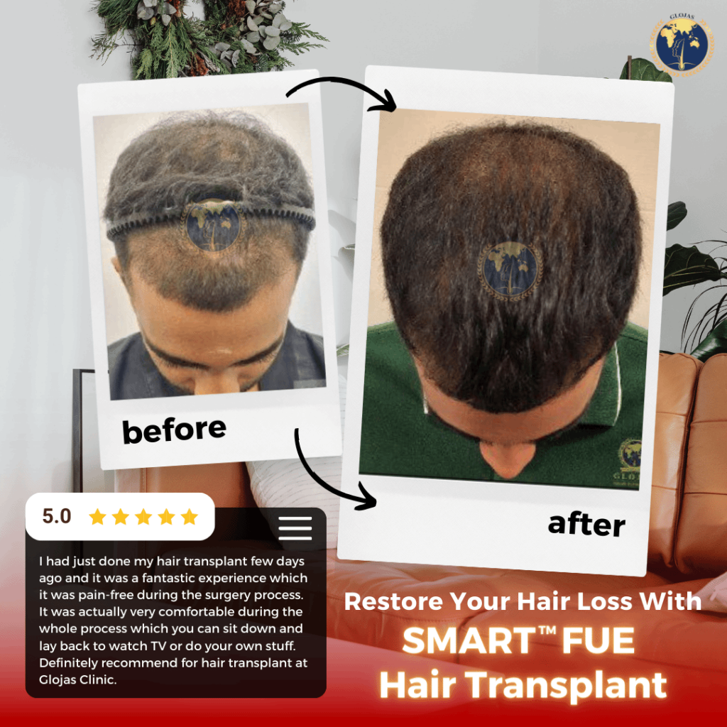 hair transplant