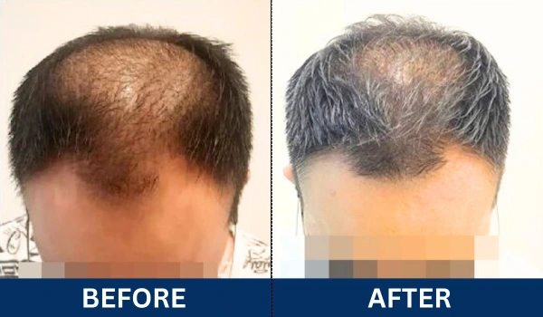 glojas hair transplant