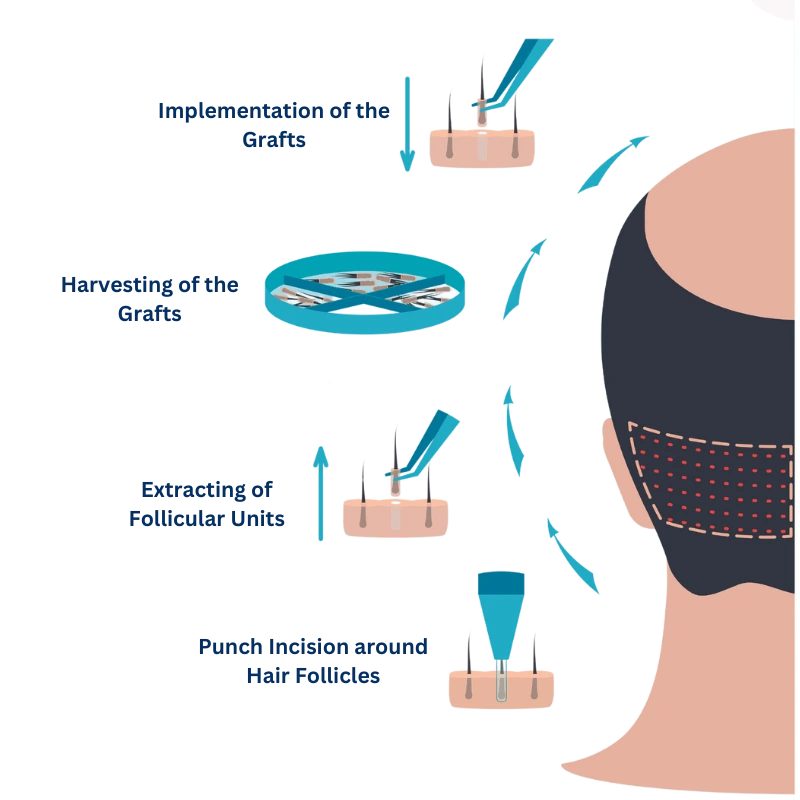 glojas hair transplant