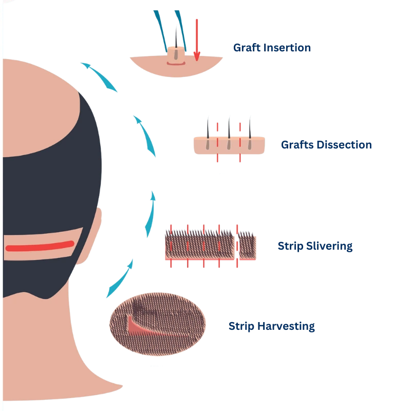 glojas hair transplant