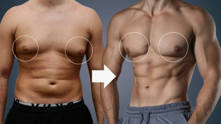 gynecomastia