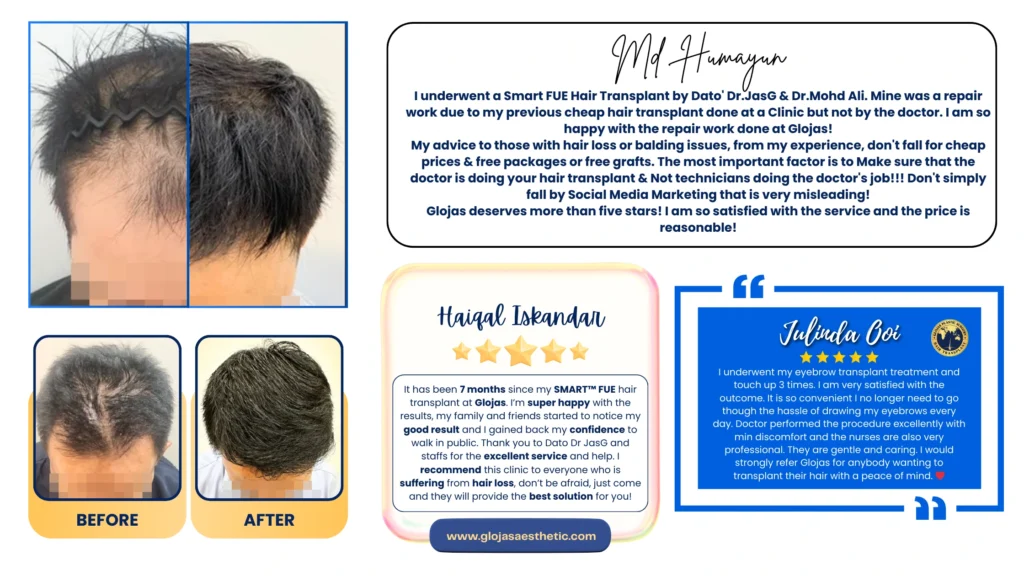 fue hair transplant