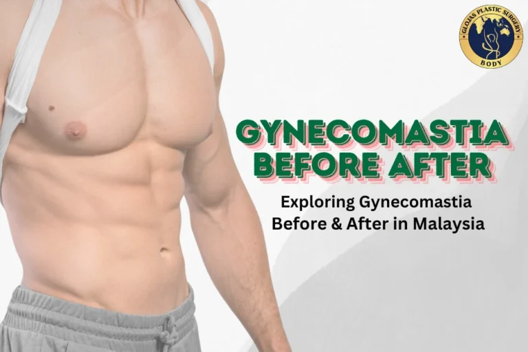 Gynecomastia Before After