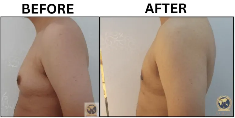 Gynecomastia Treatment In Malaysia