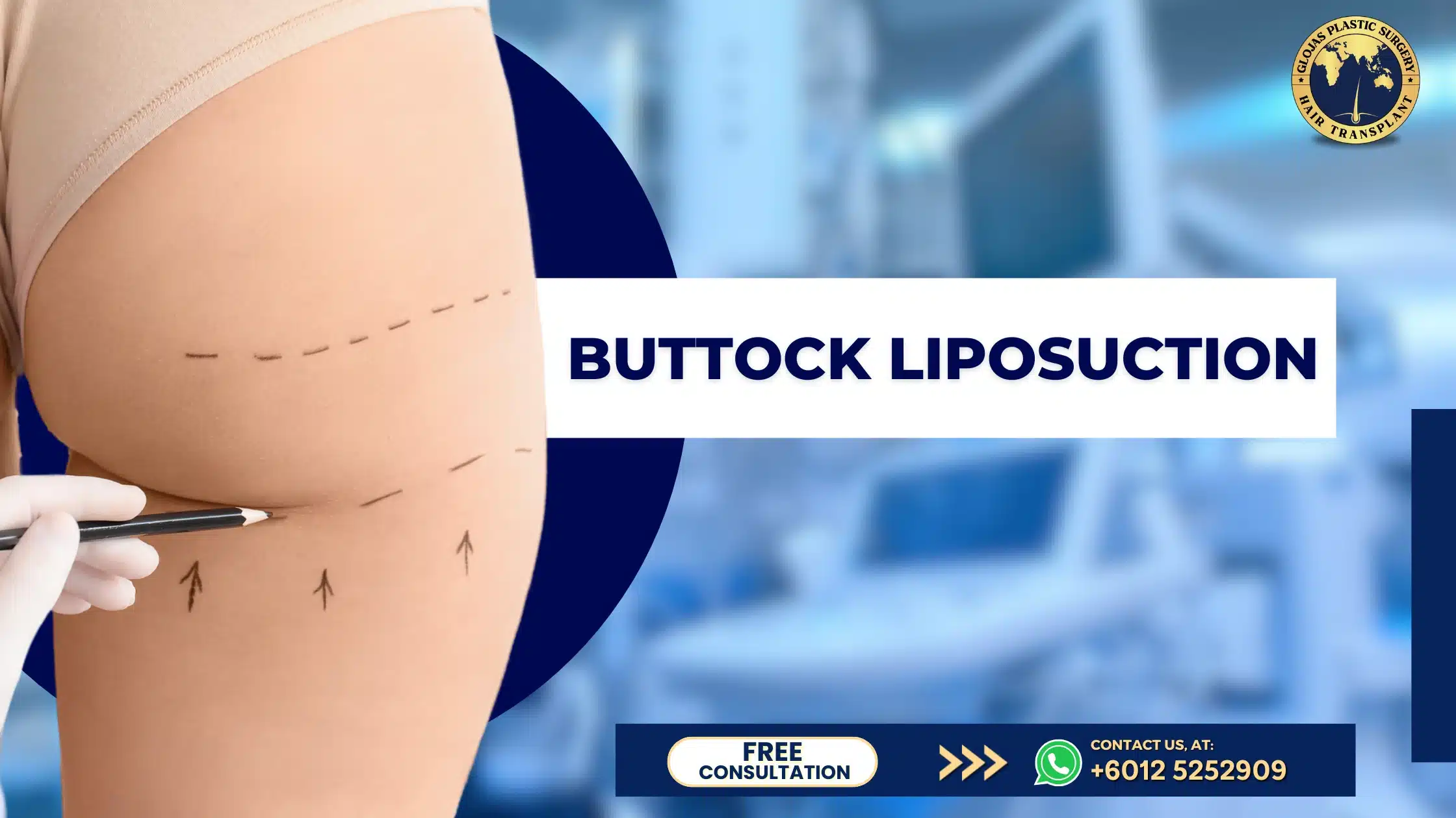 buttock liposuction