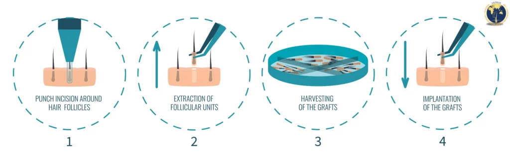 fue hair transplant