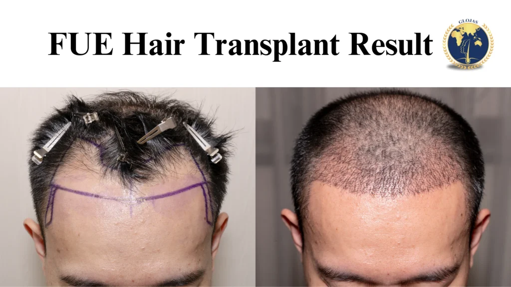 fue hair transplant