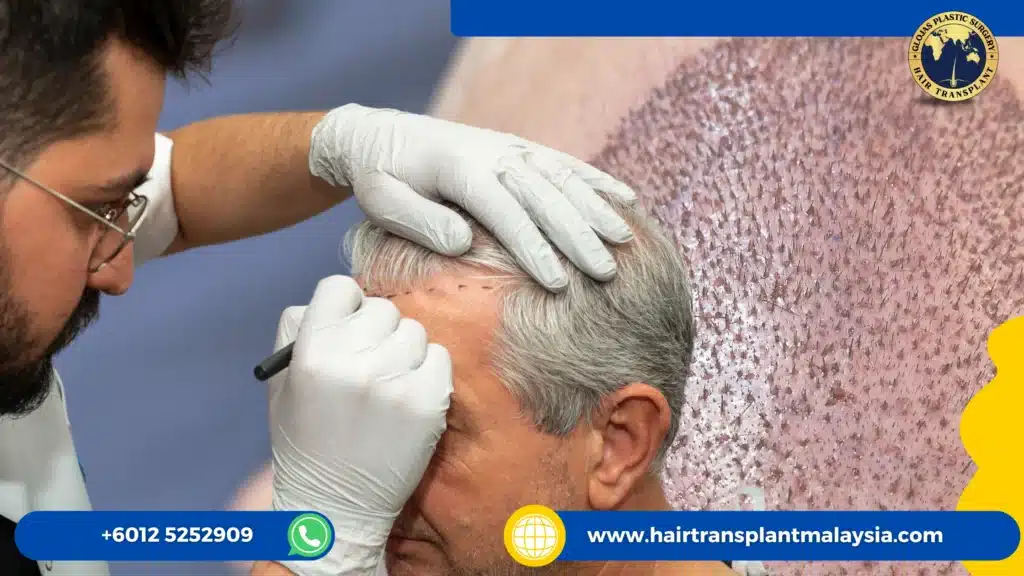 hair graft price calculator malaysia