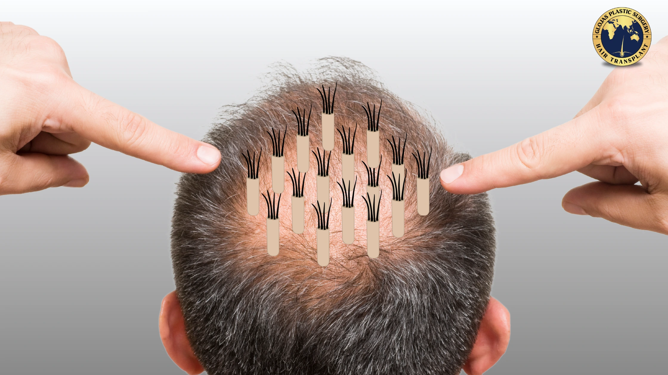 Hair Graft 101: What It Is, How It Works, and How Many You Need