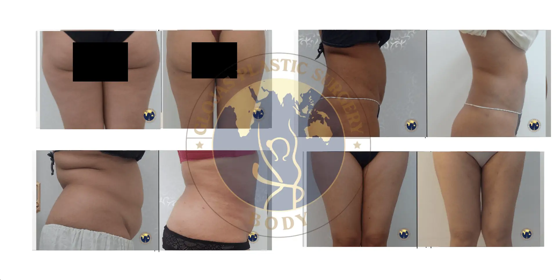 liposuction paha