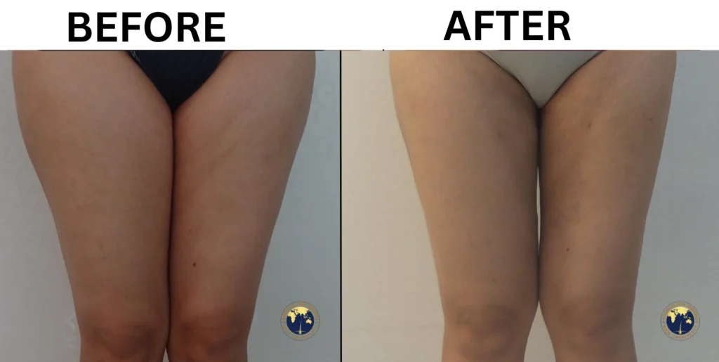 Before After Thigh Liposuction