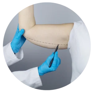 Brachioplasty liposuction