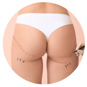 Buttocks liposuction