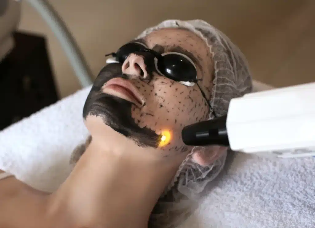 Carbon Laser Peel