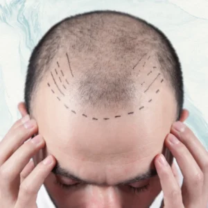 hair-transplant-malaysia-specialist-glojas