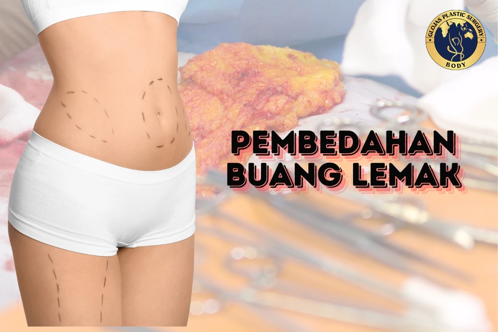 Pembedahan Buang Lemak