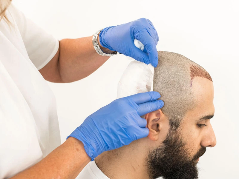 procedure-fue-hair-transplant-in-malaysia