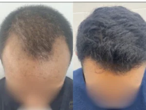 recovery-fue-hair-transplant-in-malaysia