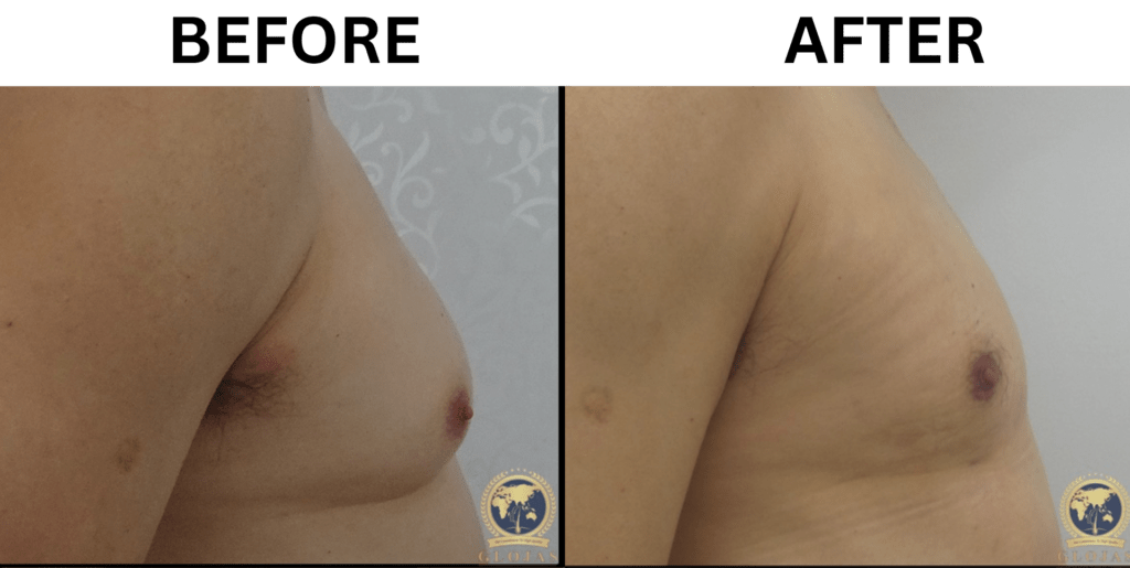 apa itu gynecomastia