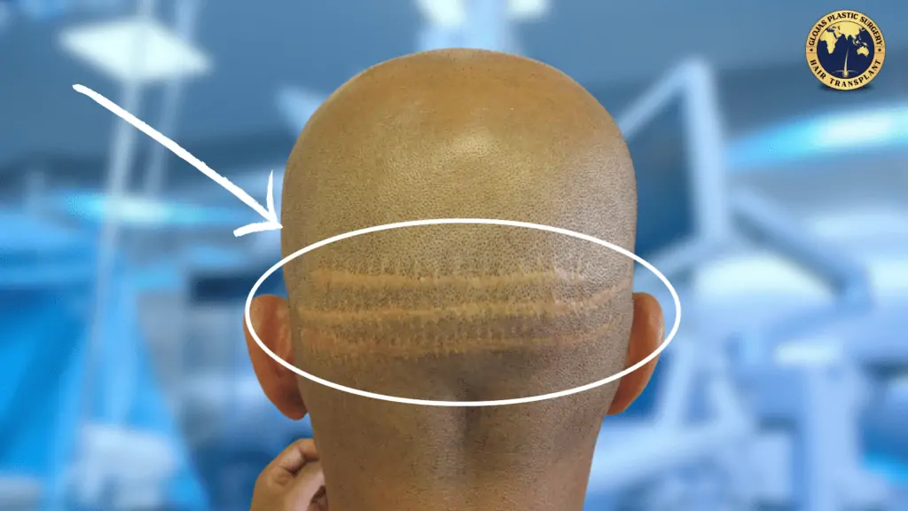 hair transplant scar