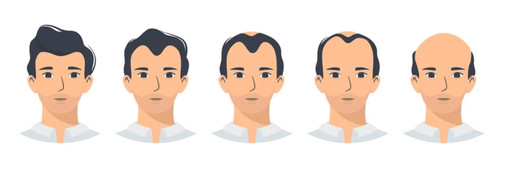 male pattern hair loss