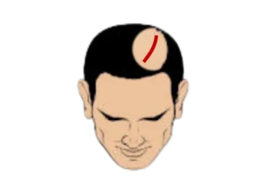 scar-fue-hair-transplant-malaysia