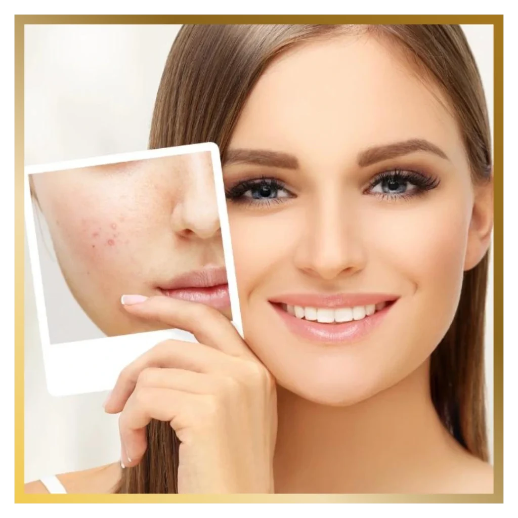 Acne & Acne Scar Treatment