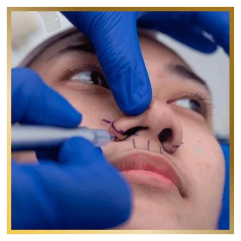plastic-surgery-malaysia-reconstructive-surgeon-alarplasty