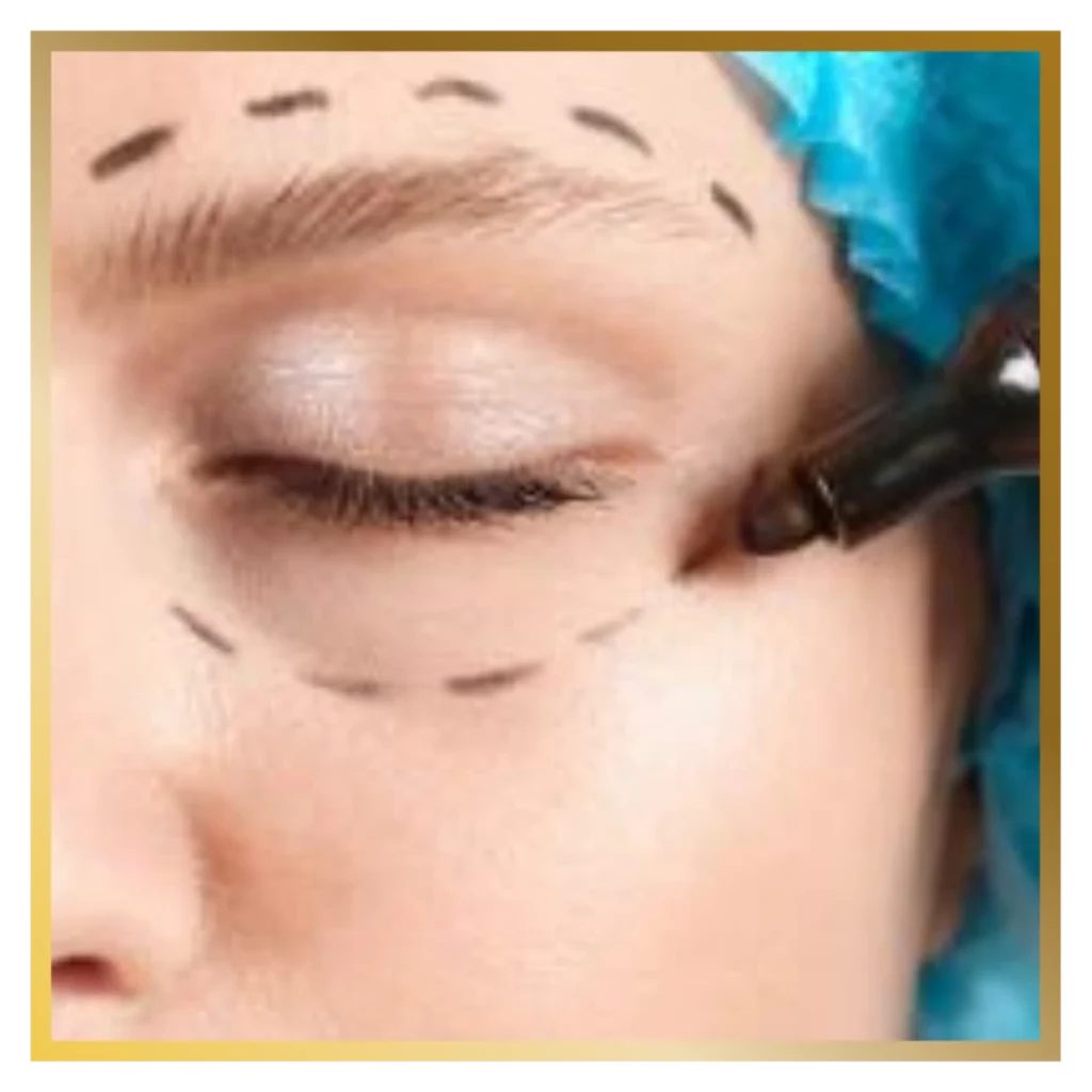 Blepharoplasty glojas