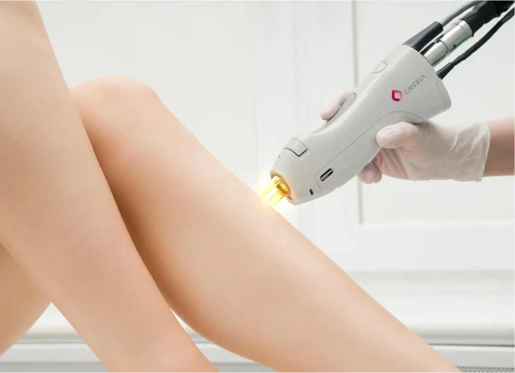 Candela Gentle YAG Laser