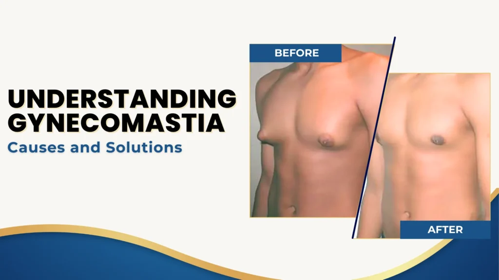 Gynecomastia Causes