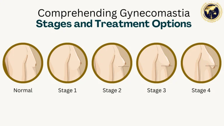 gynecomastia-stages