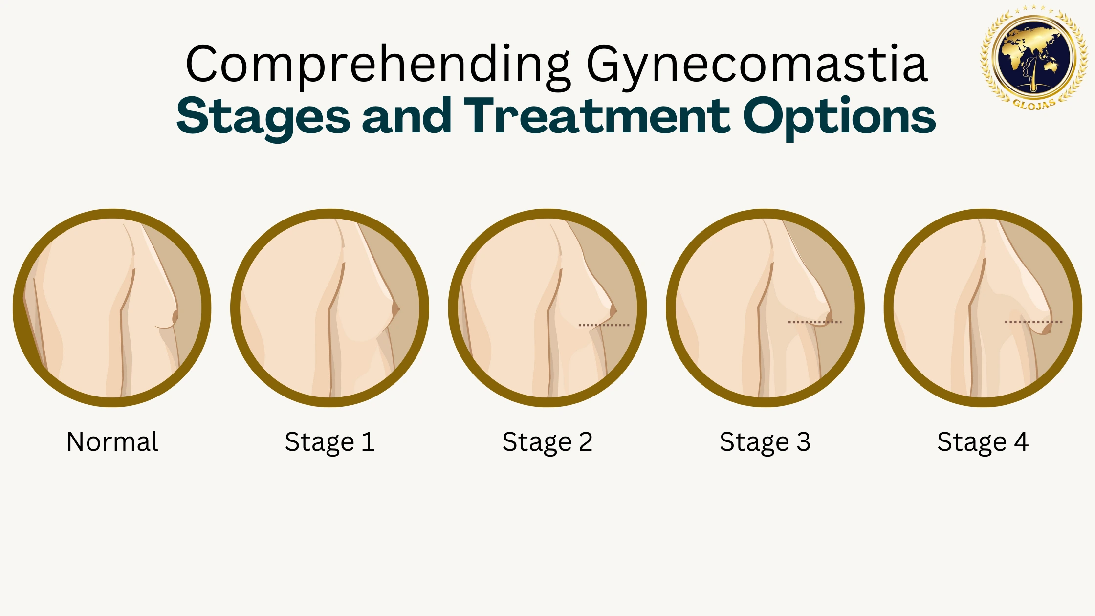 gynecomastia-stages